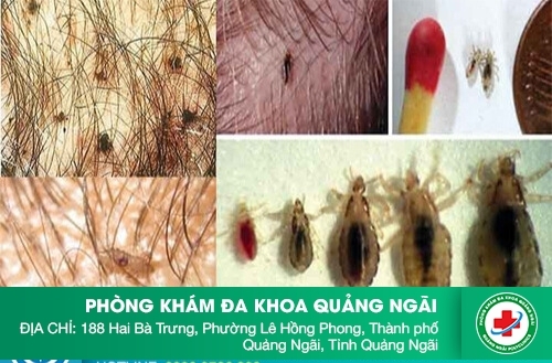 Ngứa dương vật là bệnh gì?